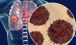 75% ung thư phổi không sớm phát hiện được, vì sao?