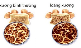 Thuốc loãng xương phải sử dụng lâu dài