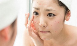Cách chăm sóc da bị mụn