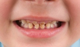 Răng sữa bị sâu, cần làm gì?
