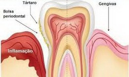 Chảy máu chân răng có thể gây mất răng