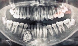 Phẫu thuật lấy gần 100 chiếc răng tí hon trong hàm một thiếu niên