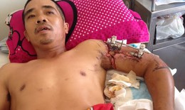 Khánh Hòa: Nối thành công cánh tay bị máy xay đá cắt gần lìa