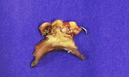 Đang uống nước bị sặc, hàm răng giả trôi vào cổ họng người đàn ông