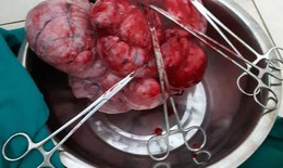 Hà Giang: Bóc tách khối u xơ khổng lồ nặng gần 5kg