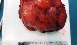 Đồng Hới: phẫu thuật cắt bỏ khối bướu giáp "khủng"