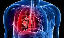 Quan niệm sai lầm về những nguy cơ dẫn tới  ung thư phổi