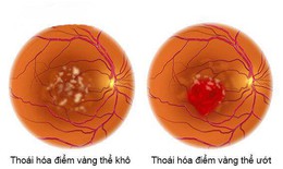 Quản lý và theo dõi bệnh thoái hoá hoàng điểm tuổi già như thế nào?