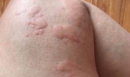Nguyên nhân gây bệnh về da – cái nhìn từ y học cổ truyền