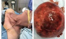 Giải thoát cho bệnh nhân lớn tuổi khỏi khối bướu khổng lồ nặng gần 1kg