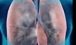 Hút thuốc lá – thủ phạm gây bệnh COPD