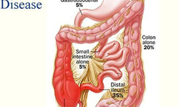 Thuốc lá và nguy cơ mắc bệnh Crohn