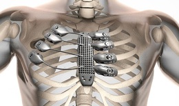 Ra đời xương in 3D tùy chỉnh