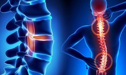Chú ý đến những bất lợi khi dùng glucosamine