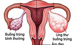 Olaparib kéo dài thời gian sống cho bệnh nhân ung thư buồng trứng