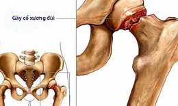 Giảm nguy cơ gãy xương nhờ dùng thuốc chống loãng xương sớm