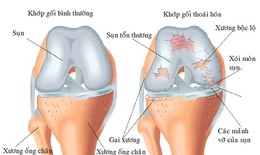 Có thể chẩn đoán thoái hóa khớp trước khi xuất hiện các triệu chứng?