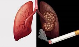 Hút thuốc - yếu tố nguy cơ của COVID-19