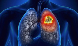 Kết hợp h&#243;a trị v&#224; liệu ph&#225;p miễn dịch trong điều trị ung thư phổi