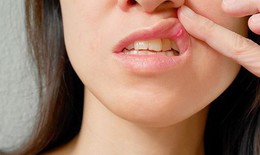 Tổn thương miệng, lòng bàn tay - triệu chứng mới của COVID-19