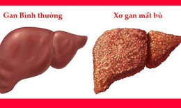 Tác dụng phụ nghiêm trọng khi dùng albumin ở bệnh nhân xơ gan mất bù