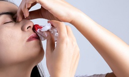 Điểm mặt thủ phạm gây chảy máu cam