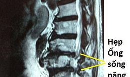 4 giờ phẫu thuật cho bệnh nhân nhiều đêm phải ngủ "ngồi"
