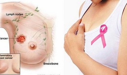 Mách bạn tránh yếu tố nguy cơ dẫn đến ung thư vú