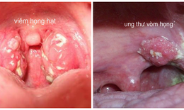 Yếu tố nào dẫn đến ung thư vòm họng?