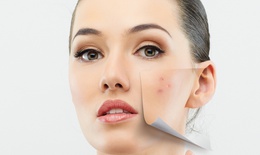 Xử trí khi bị mụn trứng cá