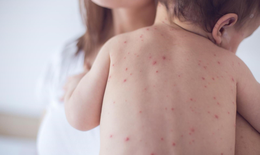 Chăm sóc trẻ sốt phát ban đúng cách
