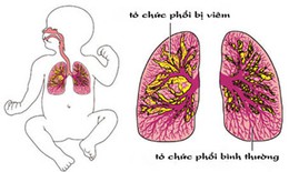 Nhận biết viêm phổi ở trẻ em