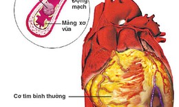 Ai dễ mắc bệnh mạch vành?