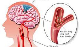 Cách nào phòng tai biến mạch máu não?