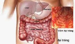 Hội chứng ruột kích thích và sản phẩm đại tràng TW28
