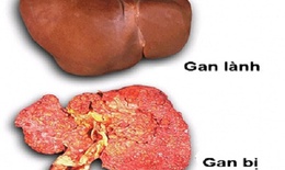 Những điều cần làm ngay để tránh ung thư gan