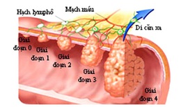 Đã có Hướng dẫn chẩn đoán, điều trị ung thư đại trực tràng mới nhất