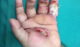 Một phút bất cẩn của người lớn khiến bé 1 tuổi nát tay vì điện giật