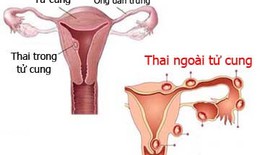 Hãy đến bệnh viện ngay nếu chị em bị đau bụng, ra máu âm đạo nhiều và kéo dài