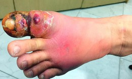 Cắt khóe móng chân tại nhà, một phụ nữ bị hoại tử nhiễm trùng nặng bàn chân