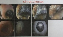 Gắp quả pin đồng hồ đã phôi màu trong thực quản bé 2 tuổi