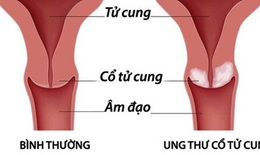 Quan hệ tình dục từ năm 16 tuổi, cô gái mắc ung thư cổ tử cung khi mới 24 tuổi