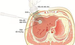 Ung thư gan: Cách phát hiện và phòng bệnh