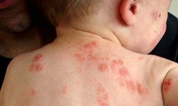 Thuốc chữa bệnh chàm
