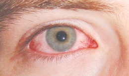 Thuốc điều trị rối loạn cương dương gây... mờ mắt