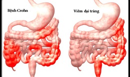 5 cách giảm triệu chứng bệnh Crohn không cần thuốc