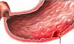 Xuất huyết dạ dày vì thuốc giảm đau
