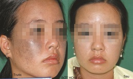 Điều trị bớt sắc tố da bẩm sinh và nám da