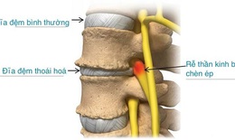 Trị đau thắt lưng thấp có nguồn gốc đĩa đệm