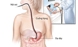 Cẩn thận khi bị polyp dạ dày